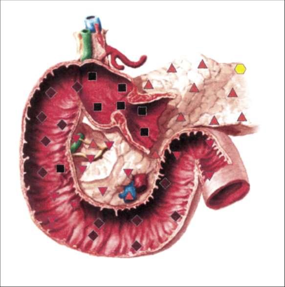 Панкреато-дуоденальная зона - функциональные нарушения моторной функции 12-типерстной кишки с дисфункцией желудочно-кишечного сфинктера.