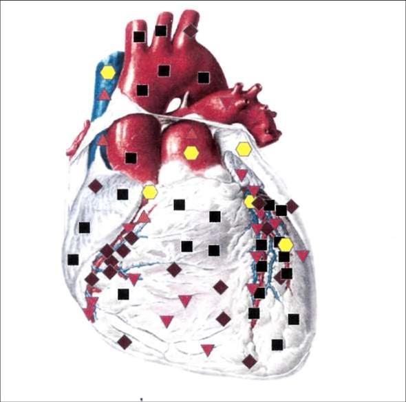 Сердце спереди - ишемические явления в сердце на фоне атеросклероза коронарных сосудов, атеросклероз аорты.