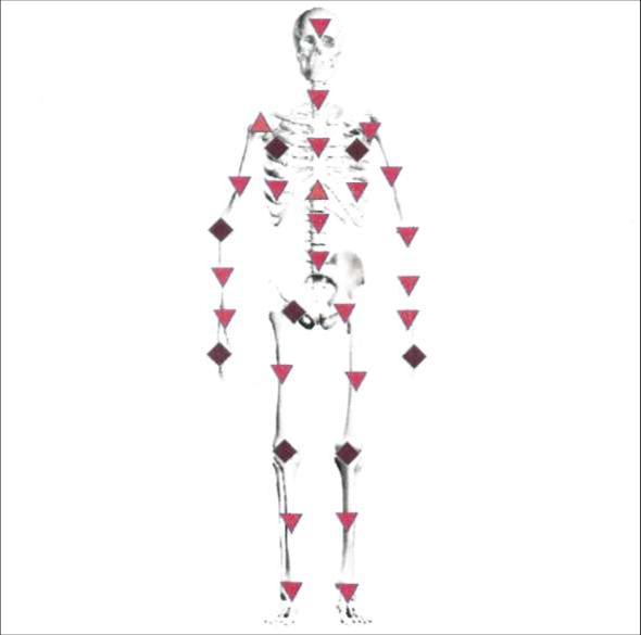 Скелет - дегенеративные изменения в крупных суставах.